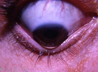 Ceratocone: sintomas em Barretos e por que diagnosticar cedo muda o caminho