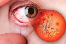 Diabetes e visao em Barretos e regiao: quando pensar em retina e retinopatia diabetica