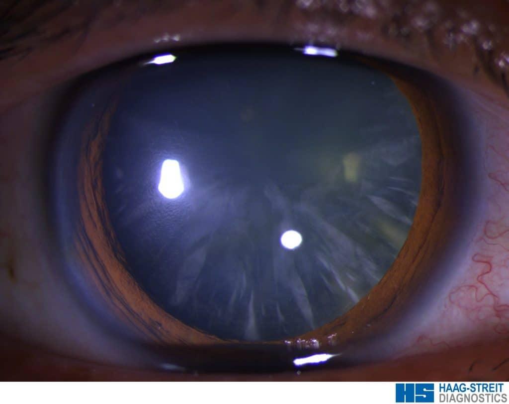 Catarata cortical