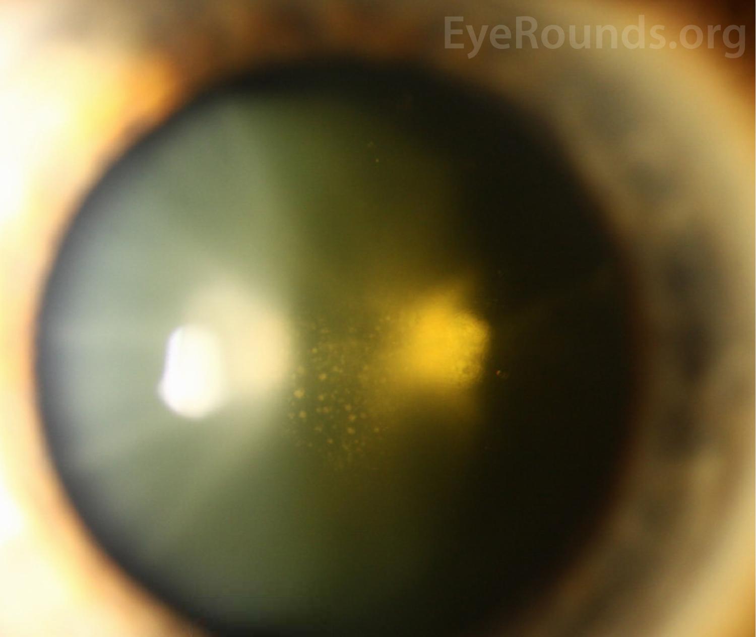 Catarata subcapsular posterior